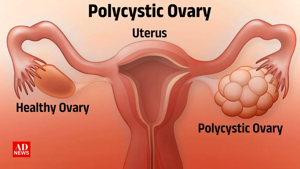 Pcod kya hota hai: क्या आपके शरीर में pcod के लक्षण हैं?
