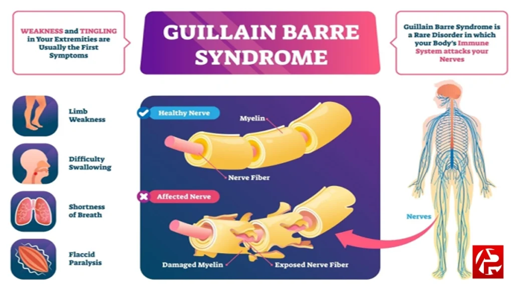 Guillain-barre syndrome: पुणे में जीबीएस के 100+ मामले, उपमुख्यमंत्री ने की मुफ्त इलाज की घोषणा